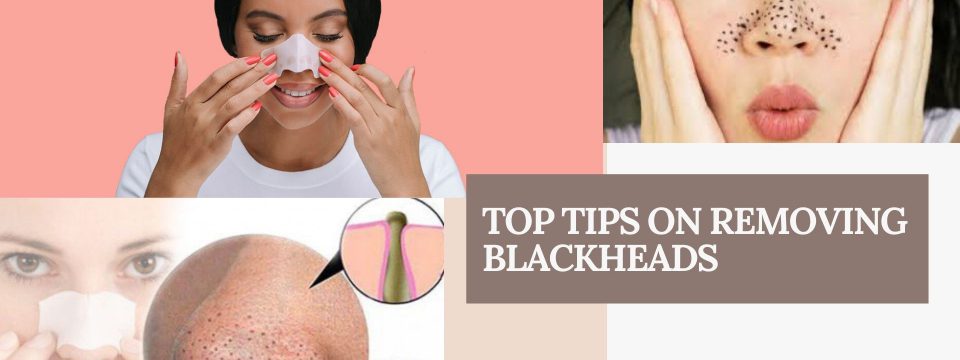 blackheads removing tips